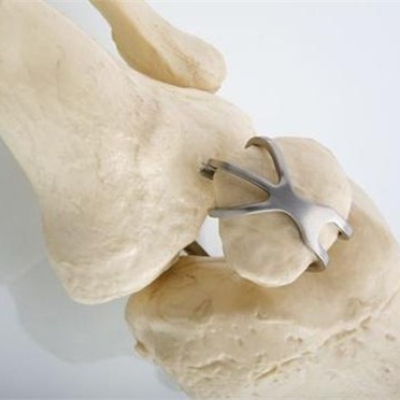 Легура титанијума која се користи у хирургији за повезивање костију